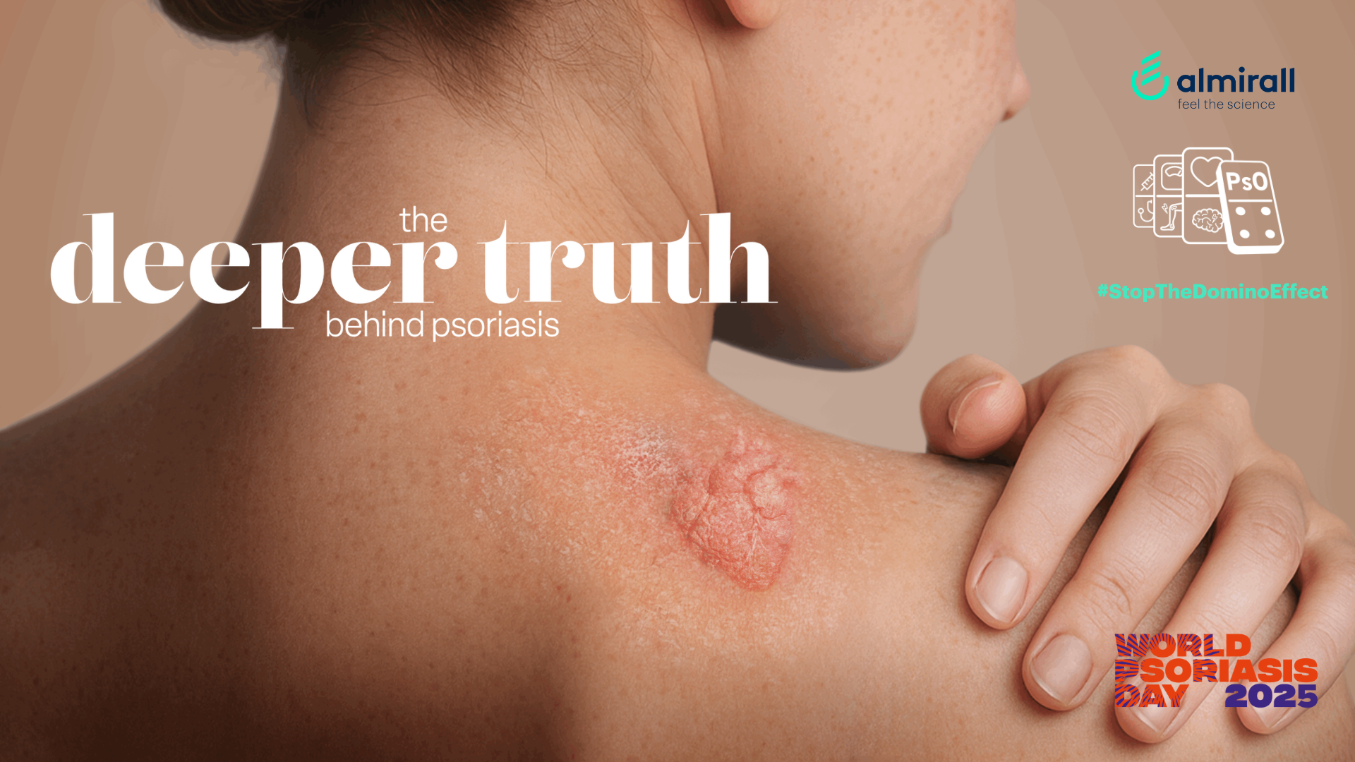 World Psoriasis Day 2025